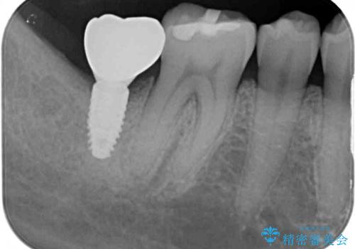 抜歯されたままの奥歯　ストローマンインプラントによる欠損補綴治療の治療後