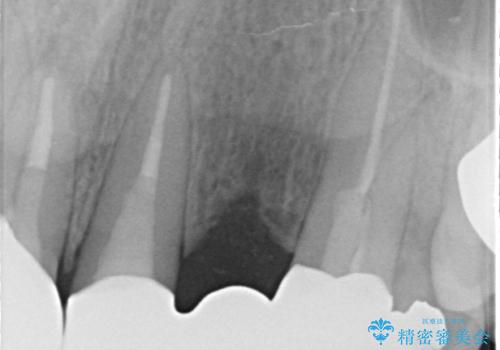 オールセラミッククラウン 気になる歯茎と被せ物の隙間の改善の治療後