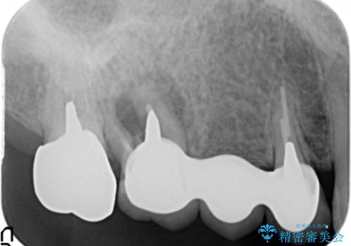 [ 歯牙破折 ]  インプラントによる咬合機能回復の治療前