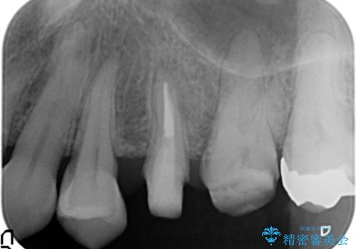 放置し崩壊した歯 セラミック治療による咬合機能回復の治療中
