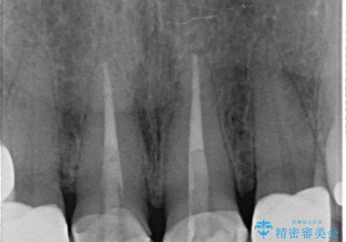 オールセラミッククラウン　前歯の劣化した古い樹脂をセラミックにの治療後