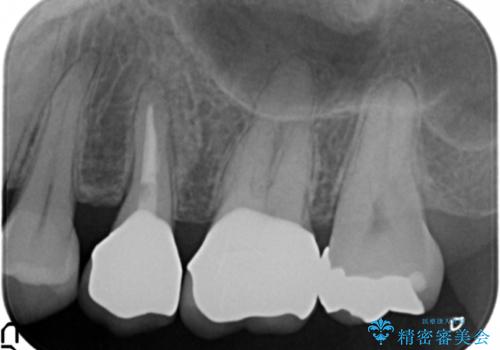 放置し崩壊した歯　セラミック治療による咬合機能回復の治療後