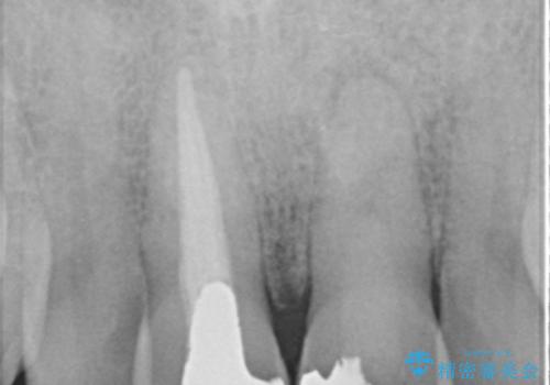 歯ぐきからの出血 膿が出る 前歯根管・セラミック治療の治療前