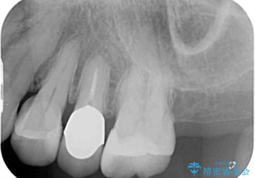 歯肉の退縮により歯根が見える　オールセラミッククラウンによる審美歯科治療の治療前