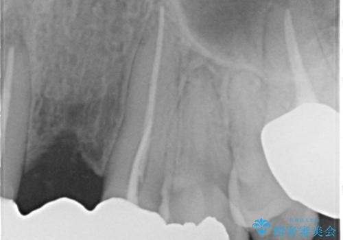 オールセラミッククラウン 気になる歯茎と被せ物の隙間の改善の治療前