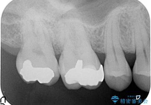 奥歯のゴールドインレーによる虫歯治療の治療後