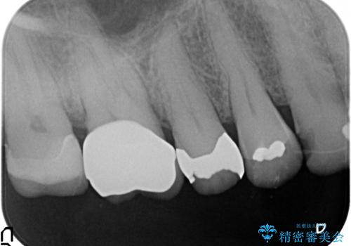 オールセラミッククラウン・セラミックインレー 歯茎より深い虫歯の治療の治療後