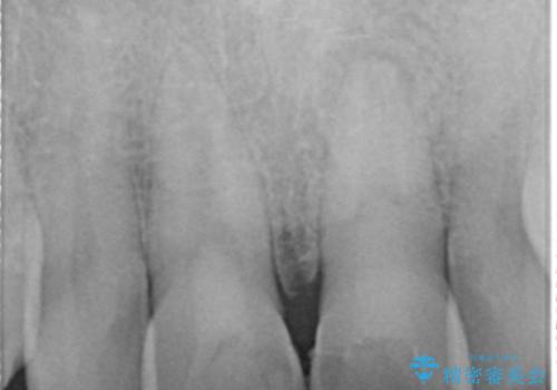 歯ぐきからの出血 膿が出る 前歯根管・セラミック治療の治療前