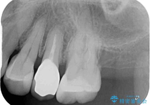 歯肉の退縮により歯根が見える オールセラミッククラウンによる審美歯科治療の治療後