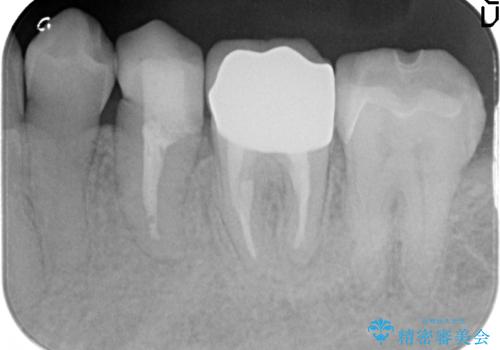 オールセラミッククラウン 銀歯を白くの治療後