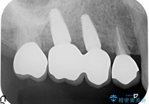 [ 歯牙破折 ]  インプラントによる咬合機能回復の治療後