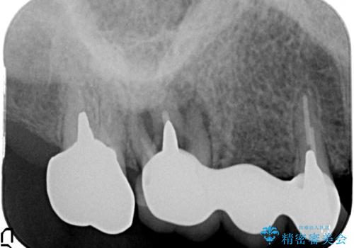 [ 歯牙破折 ]  インプラントによる咬合機能回復