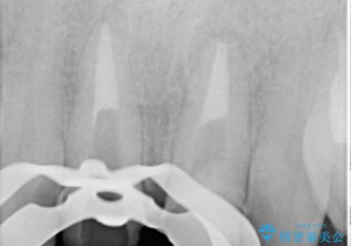 歯ぐきからの出血 膿が出る 前歯根管・セラミック治療の治療後