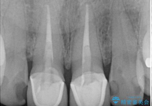 オールセラミッククラウン 前歯の劣化した古い樹脂をセラミックにの治療前