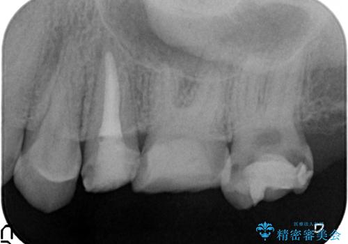 オールセラミッククラウン 痛みでものが咬めない歯の治療の治療前