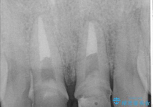歯ぐきからの出血　膿が出る 前歯根管・セラミック治療の治療前