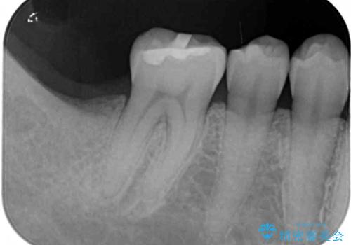 抜歯されたままの奥歯 ストローマンインプラントによる欠損補綴治療の治療前