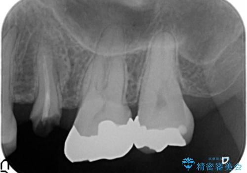 放置し崩壊した歯　セラミック治療による咬合機能回復の治療前