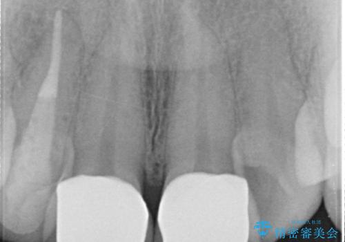オールセラミッククラウン　長期間放置してきた前歯の虫歯治療の治療後