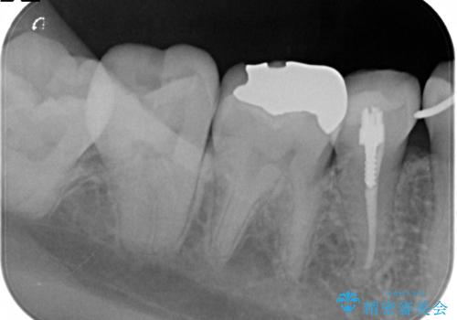 目立つ銀歯を白くしたい セラミック治療の治療前