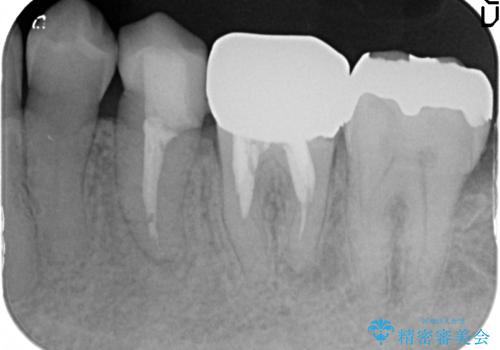 オールセラミッククラウン 銀歯を白くの治療前