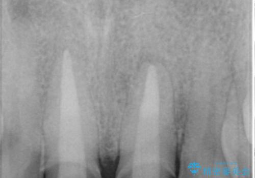 歯ぐきからの出血 膿が出る 前歯根管・セラミック治療の治療中
