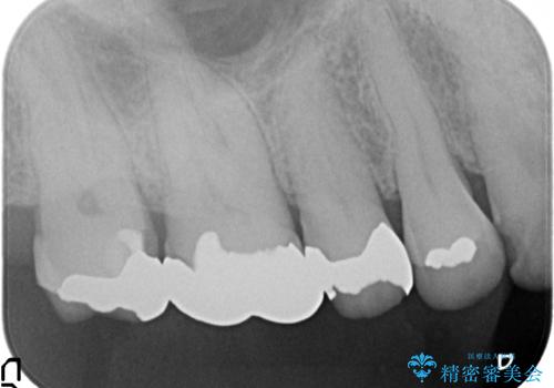 オールセラミッククラウン・セラミックインレー 歯茎より深い虫歯の治療の治療前