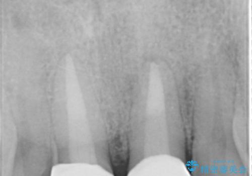 歯ぐきからの出血　膿が出る 前歯根管・セラミック治療の治療後