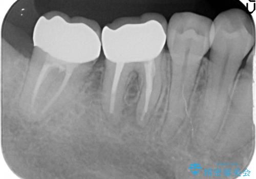 オールセラミッククラウン　欠けてしまった奥歯の治療の治療後