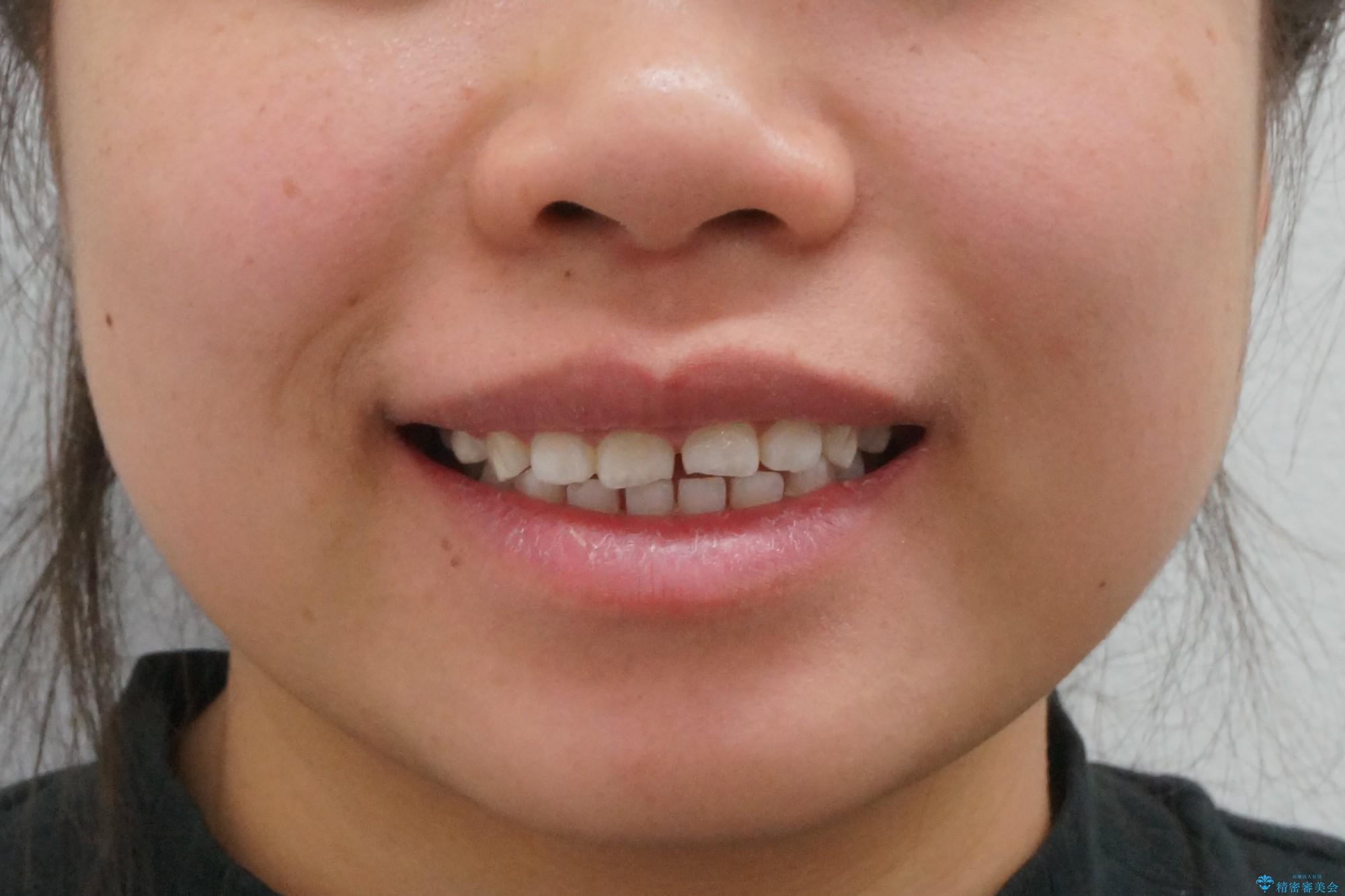 インビザライン　気になるすきっ歯の改善の治療前（顔貌）