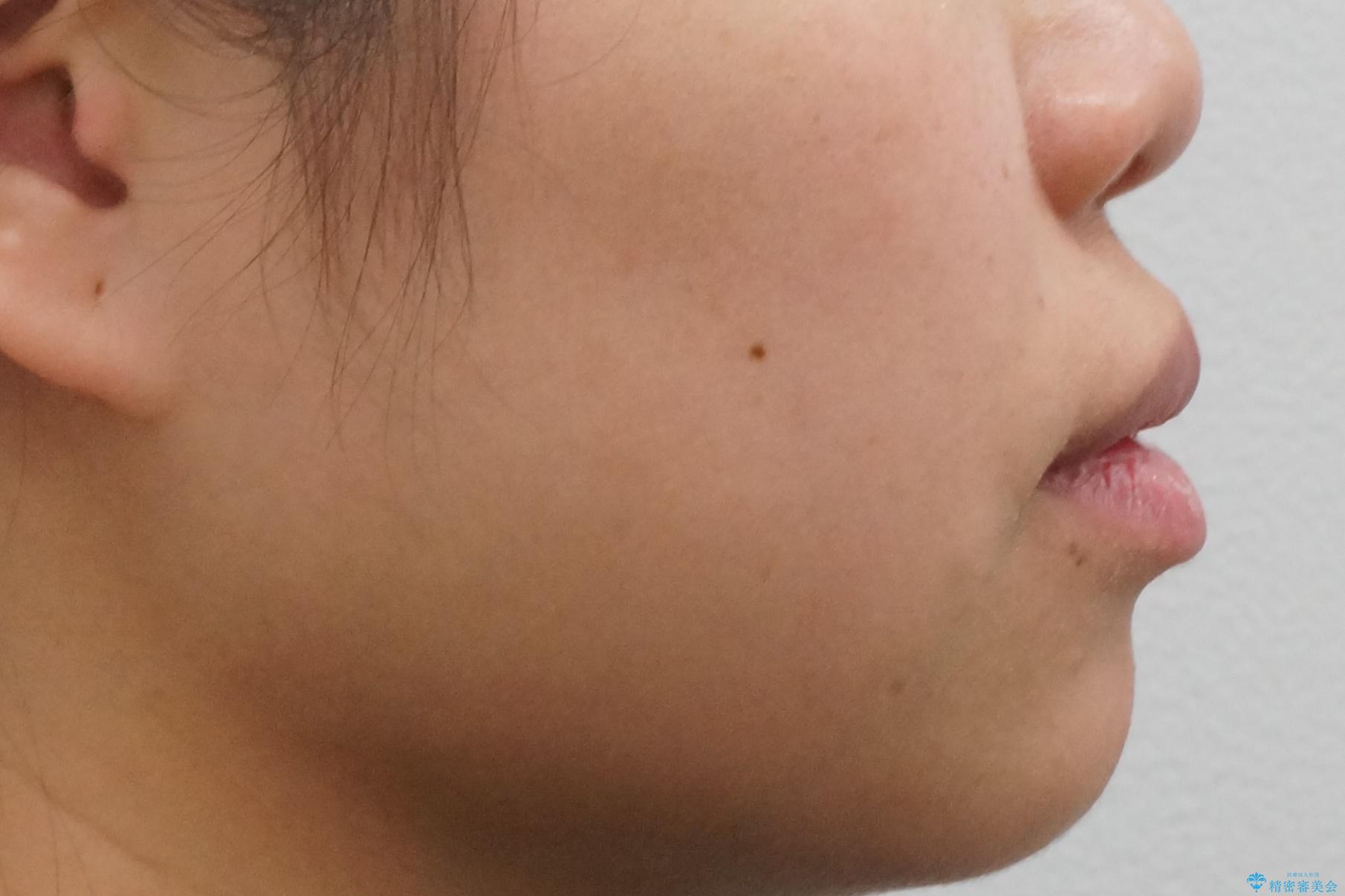 インビザライン 気になるすきっ歯の改善の治療前(顔貌)