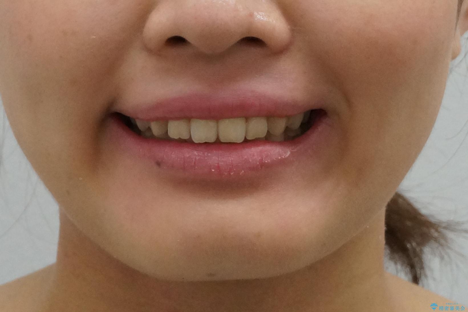 前歯のねじれ 乳歯を残して矯正治療の治療後(顔貌)