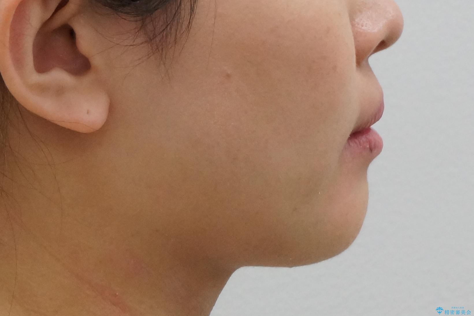 前歯のねじれ 乳歯を残して矯正治療の治療後(顔貌)