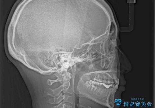 欠損と残存乳歯 矯正治療とインプラント治療の治療前