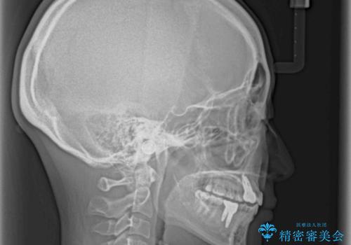 欠損と残存乳歯 矯正治療とインプラント治療の治療後