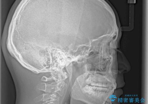 口元の突出感と叢生 ワイヤー装置による抜歯矯正の治療後