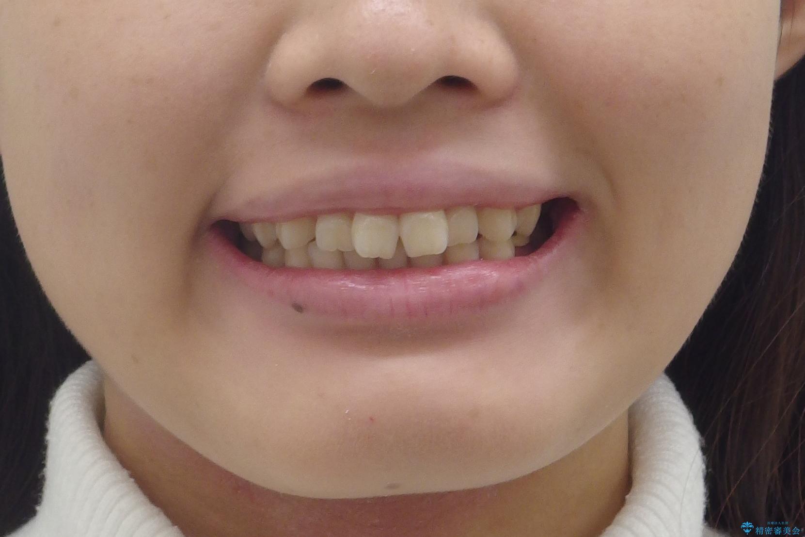 前歯のねじれ　乳歯を残して矯正治療の治療前（顔貌）