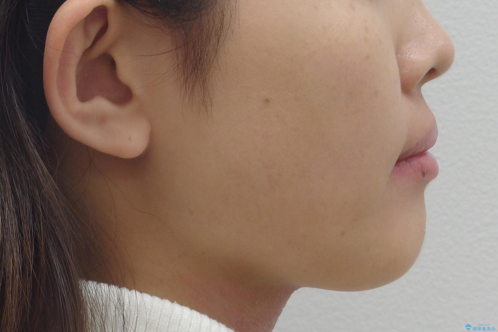 前歯のねじれ 乳歯を残して矯正治療の治療前(顔貌)