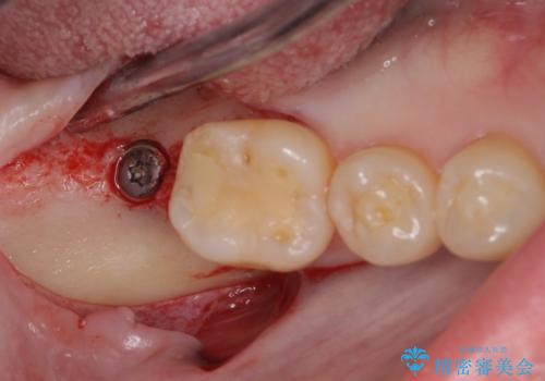 抜歯されたままの奥歯　ストローマンインプラントによる欠損補綴治療の治療中