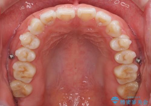 インビザライン 気になるすきっ歯の改善の治療中