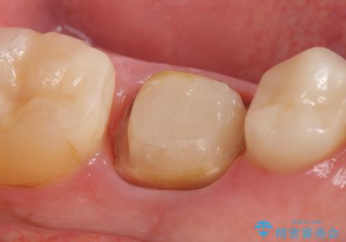 オールセラミッククラウン 銀歯を白くの治療中