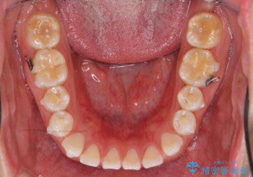 インビザライン 気になるすきっ歯の改善の治療中