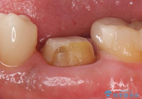 オールセラミッククラウン 銀歯を白くの治療中