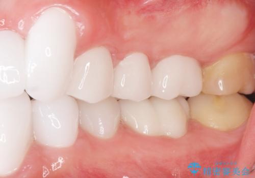 歯並びをきれいにしたい、歯を真っ白にしたい 40代男性の治療後