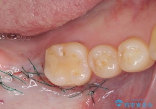 抜歯されたままの奥歯　ストローマンインプラントによる欠損補綴治療の治療後
