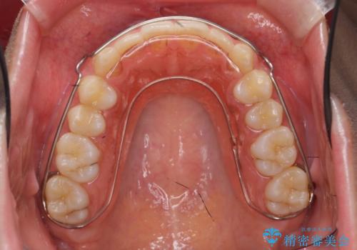 マウスピース矯正　下顎前歯のがたつきの改善の治療後