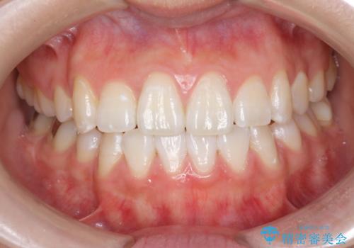 オフィスホワイトニングで歯を白く!の治療後