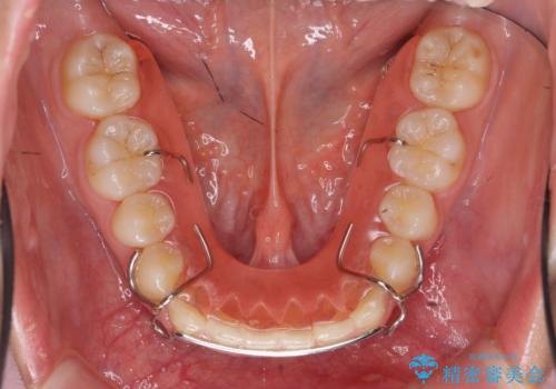 マウスピース矯正 下顎前歯のがたつきの改善の治療後