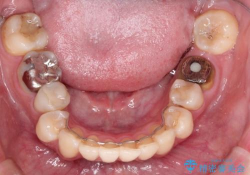 目立つ銀歯を白くしたい セラミック治療の症例 治療前