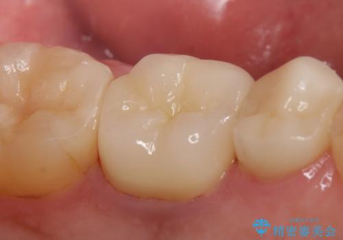 オールセラミッククラウン 銀歯を白くの治療後